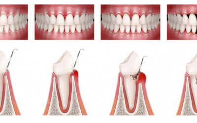 Periodontitis: qué es, síntomas y cómo prevenirla